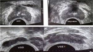 Ultrassonografia transretal demonstrando dilatação das vesículas seminais (A) e calcificações na linha média prostática (B) 