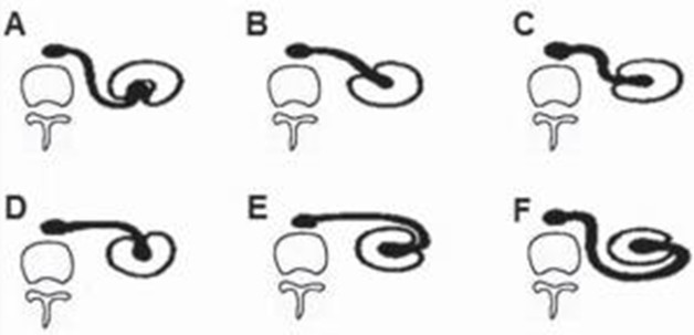 Anomalias de rotação renal. Ilustração esquemática do rim primitivo fetal (A), rim normal do adulto (B), rotação incompleta (C), hiperrotação (D), hiperrotação exagerada (E) e rotação invertida (F). Adaptado de Prando et al.