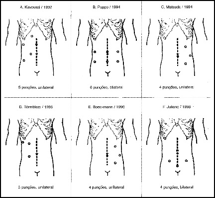 Figura 1. Evolução das punções para ureterólise laparoscópica. Fonte: Juliano et al. Arq Med Fundação ABC. 1999;22:10-2. 