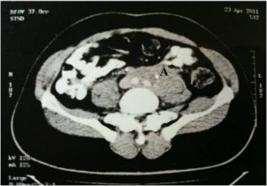  Figura 3 Tomografia computadorizada de abdome com janela pélvica mostrando (A) massa retroperitoneal infiltrada envolvendo a parede lateral pélvica, as artérias ilíacas comuns, ureteres distais, com infiltração da porção anterior do músculo íleo psoas.